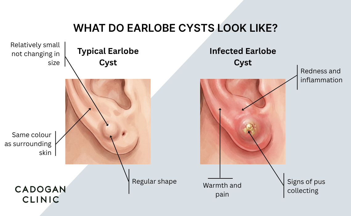 An infographic showing the difference between a benign earlobe cyst and an infected earlobe cyst.